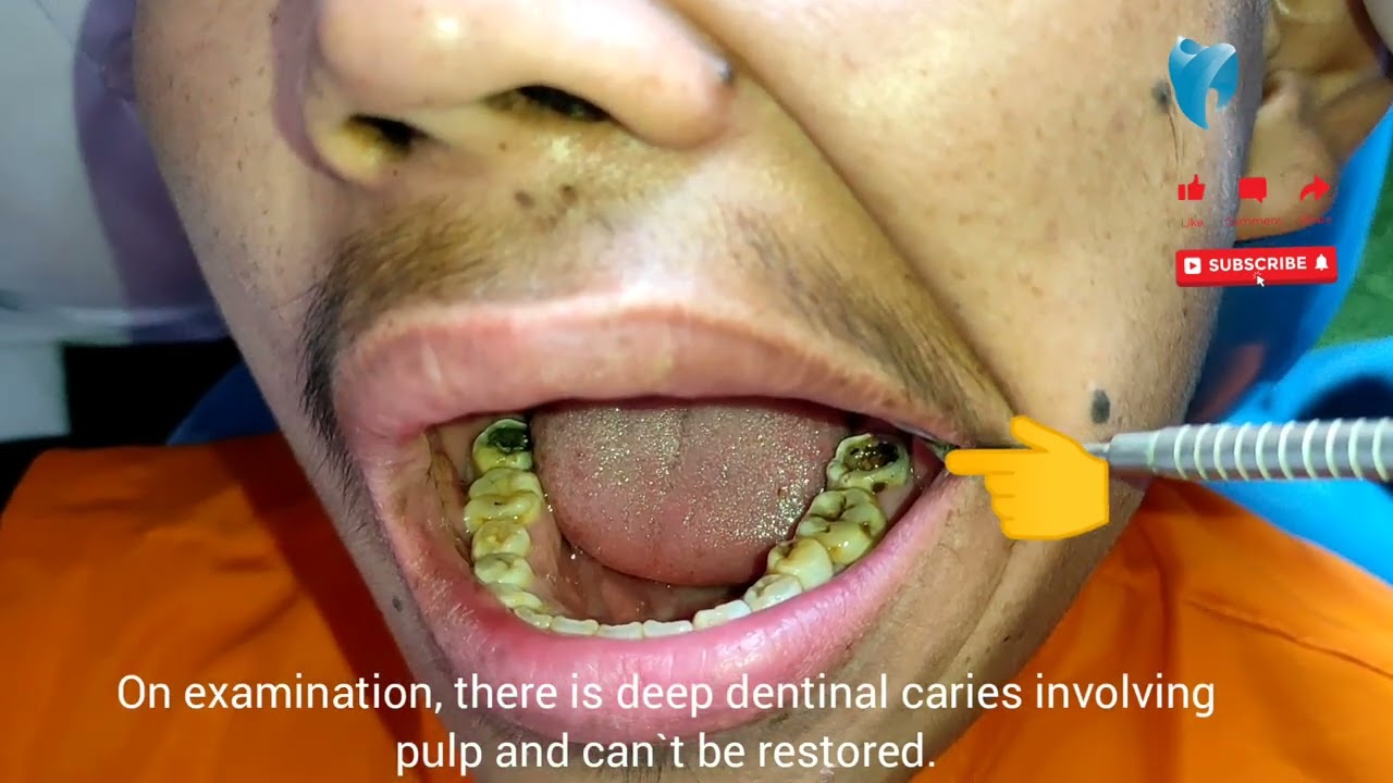 Dental Caries leads to extraction of Tooth समयमै दाँत नभर्दा दाँत