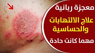 على الرغم من فوائدها، تؤدي بعض الأطعمة إلى الإصابة بالحساسية للأشخاص، فما هي أبرز هذه الأطعمة؟