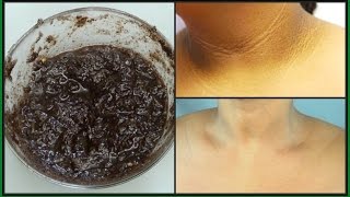 How To Get Rid Of Dark Neck Fast | 100% Natural | Lightened Dark Neck Naturally | Khichi Beauty