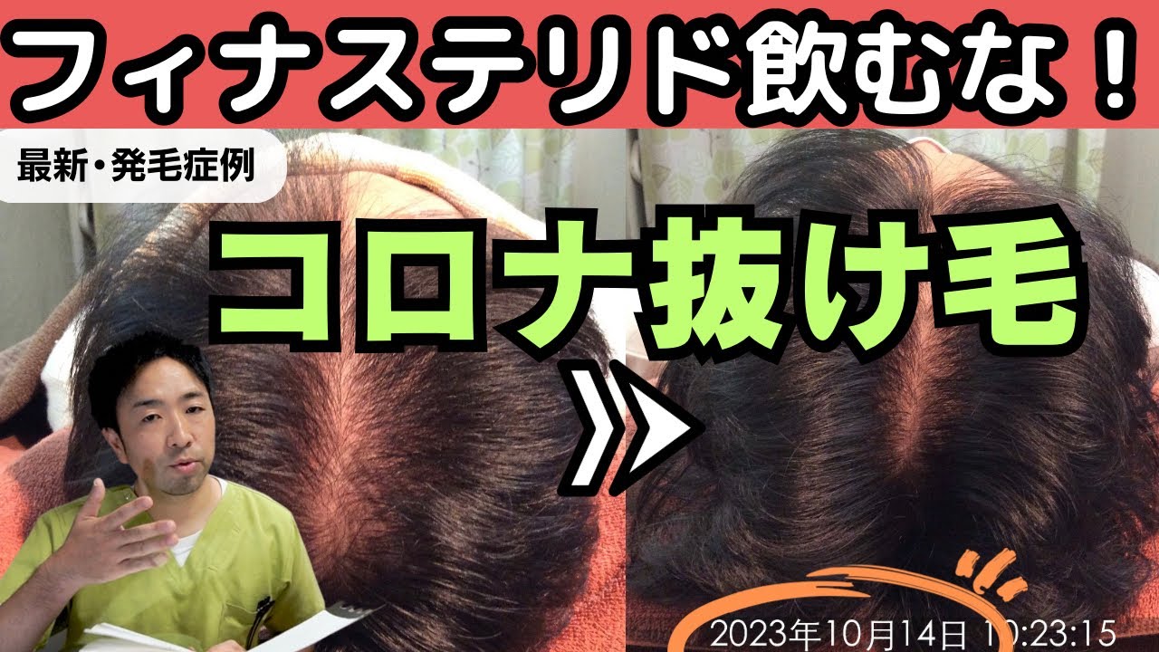 【薄毛改善】コロナ後遺症の抜け毛改善例 6日前撮影の最新発毛症例を解説 - YouTube