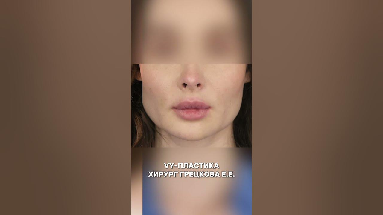 Хейлопластика - Клиника пластической хирургии и косметологи Эпиона Медикус