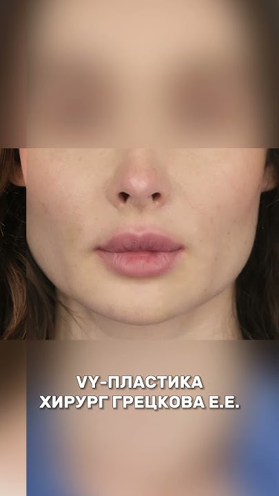 Vy пластика фото
