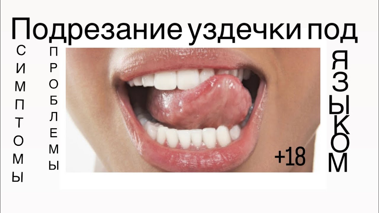 Когда требуется подрезание уздечки языка?#стоматология #клиникамосква #зубы