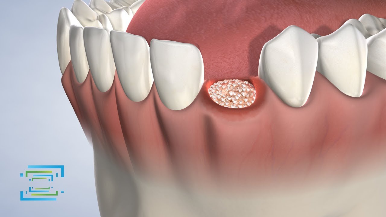 Socket Preservation at Fresno Oral Maxillofacial Surgery & Dental