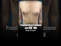 Male Breast Reduction | Grade 2A Gynecomastia Transformation