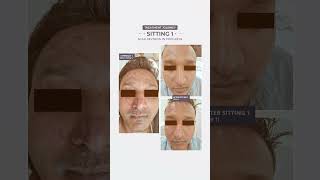✨ MNRF Treatment Results After 4 Sittings | Acne Scar & Pore Improvement ✨ #Shorts #YouTubeShorts