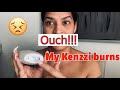 My Kenzzi burned me | Kenzzi review | My Kenzzi gets hot | Should I buy a Kenzzi | IPL Laser |