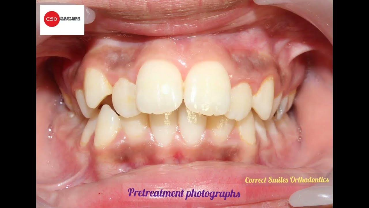 Before and After Orthodontic (braces) treatment, Non extraction