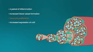 Causeway: molecular pathology of tendinopathy