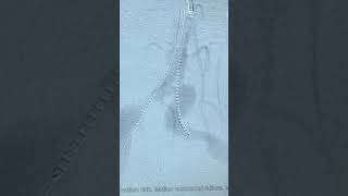 %90 Darlık Olan Bilateral Aorta İlliak Lezyonuna Her İki El Bileğinden Başarılı Pta Stent İşlemi..