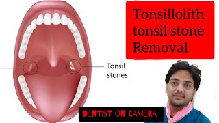 Tonsil stone | Tonsillolith | Live Removal of Tonsil stones | symptoms & treatment dentistoncamera