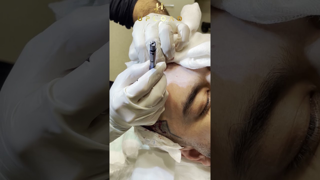 Hair Transplant Istanbul