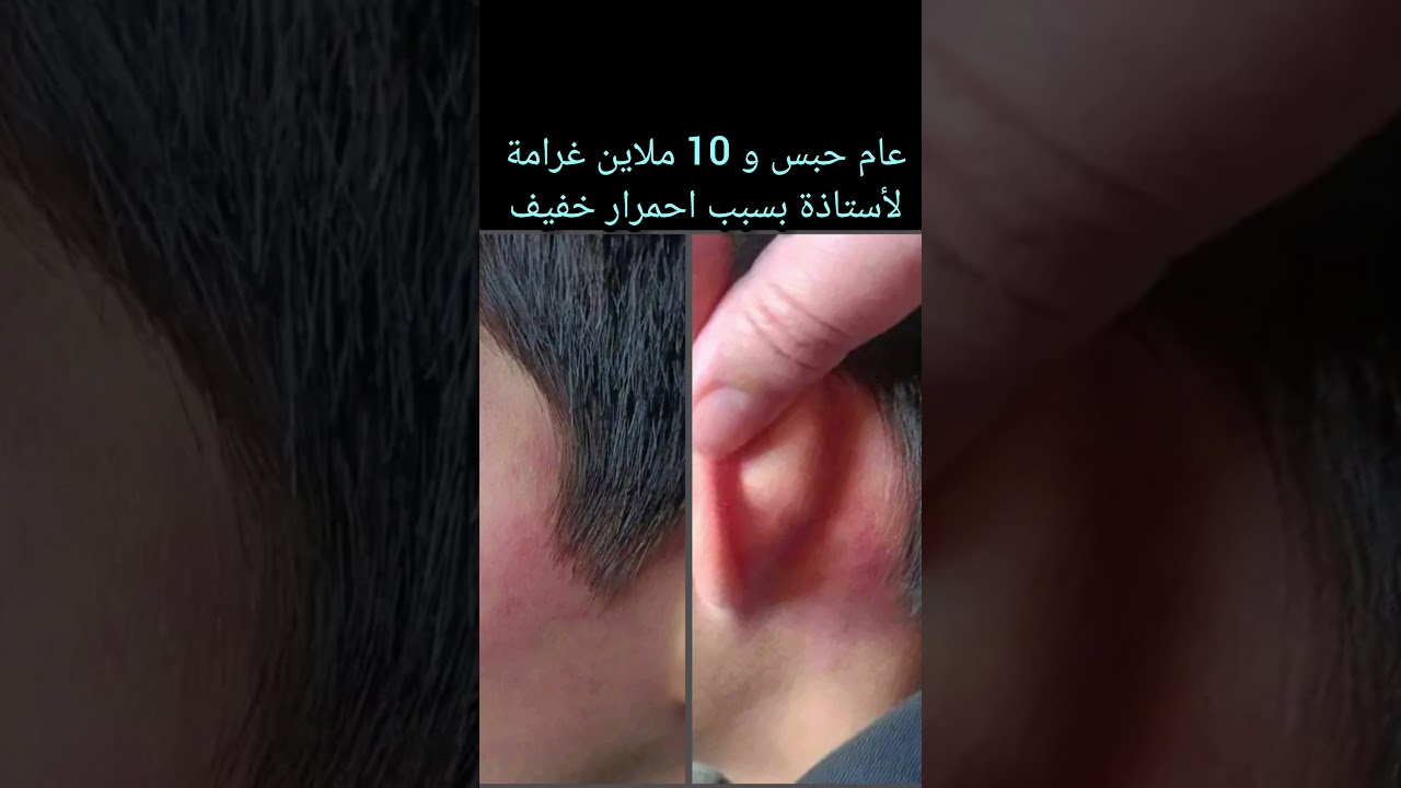 عام حبس و 10 ملاين غرامة بالجزائر العاصمة لأستاذة بسبب احمرار خفيف خلف و أمام الأذن