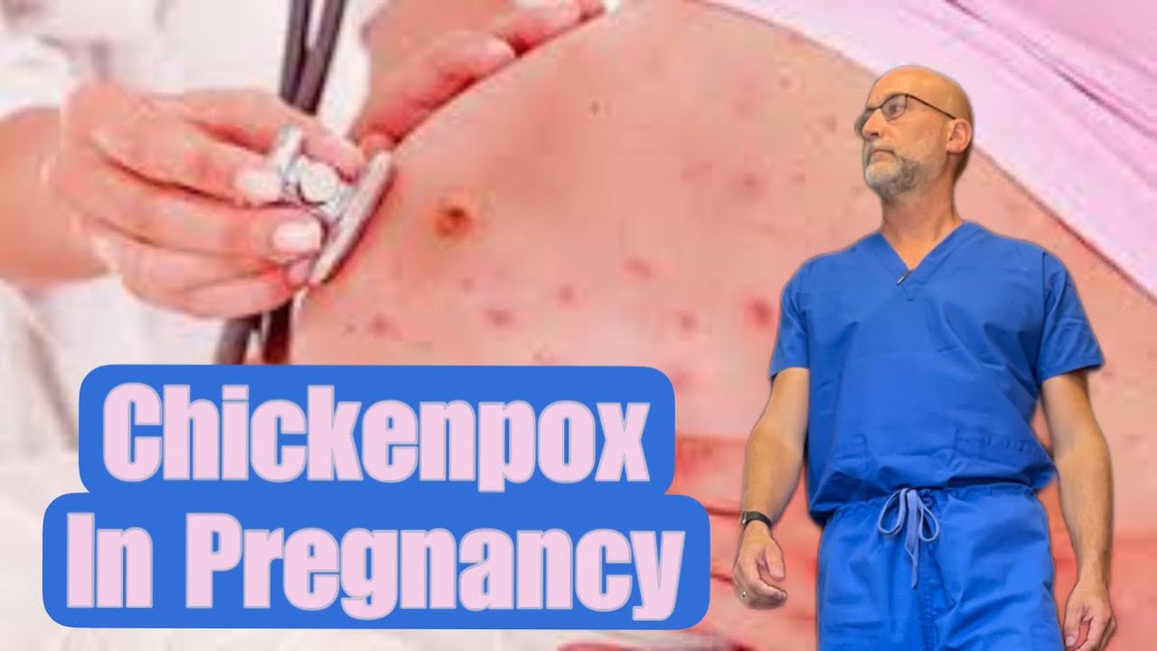 Chickenpox in pregnancy