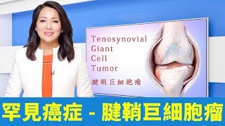 关节反复肿胀疼痛 当心罕见肿瘤 腱鞘巨细胞瘤 膝盖 膝关节 手术 大纪元