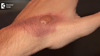 How to treat a burn blister at home? Tips to  avoid burn scar - Dr. Pavan Murdeshwar