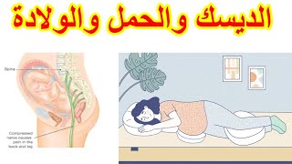 الديسك والحمل والولاده