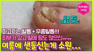 파고드는 발톱 + 무좀발톱! 피부가 얇고 발에 땀도 많으신 고객님.. 여름에 샌들신는 소원 이룰 수 있도록♥ #레푸스 #발톱 #무좀발톱 #내성발톱 #발관리 ​#레푸스 #레푸스산본