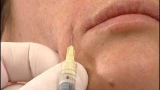 L'acido ialuronico - Il dermatologo Prof. Antonino Di Pietro