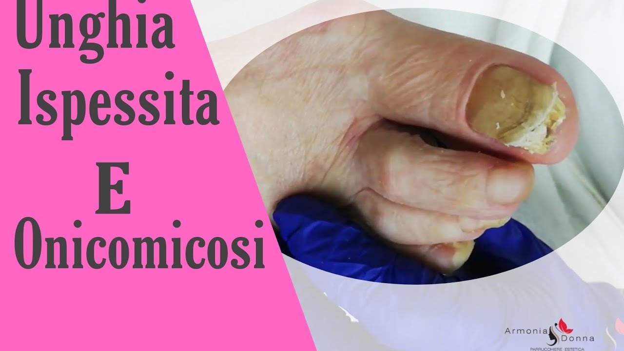 unghia-ispessita-e-onicomicosi-youtube