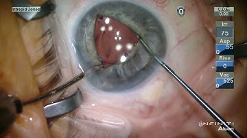 Iris Suture Fixation of a 3pc PCIOL