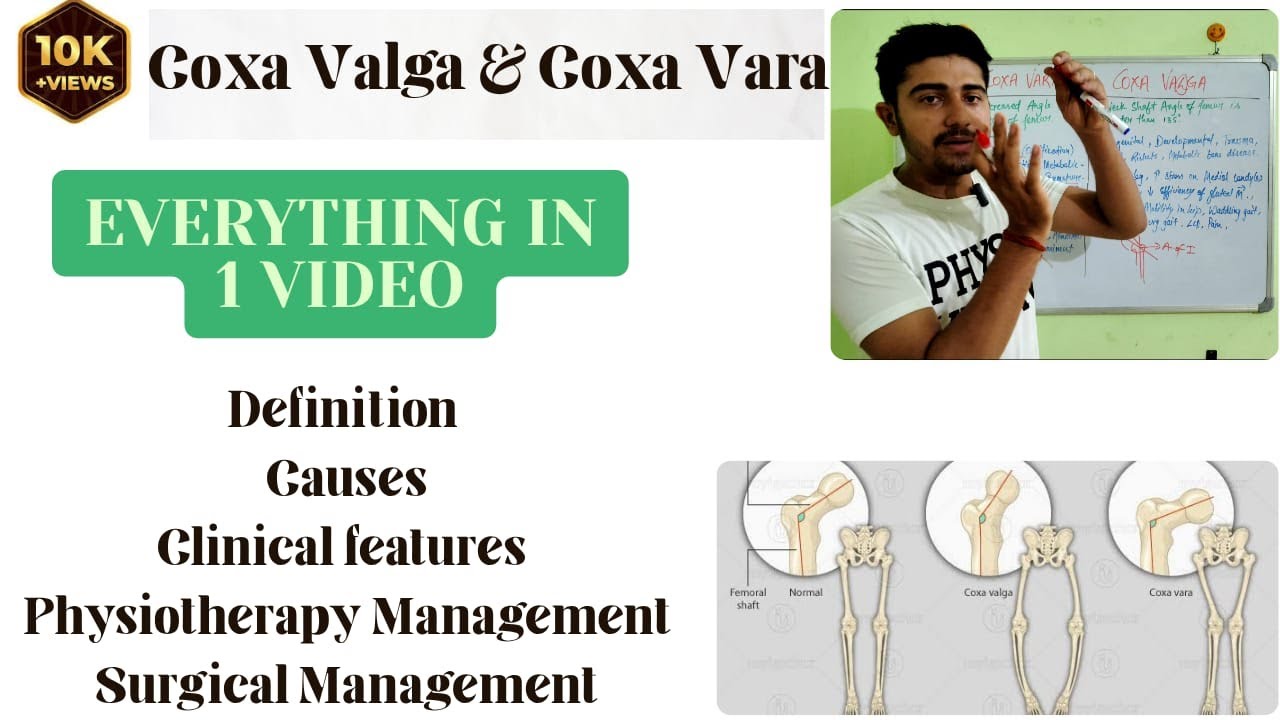 Coxa vara and Coxa Valga | Knock knee & Bow leg l Causes, Clinical features, Management
