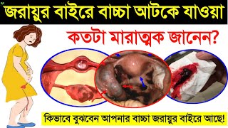 জরযর বইর বচচ আস কতট মরতমক একটপক পরগনযনস ক ও কন হয? Ectopic Pregnancy