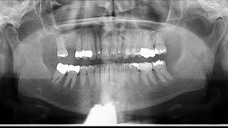 Quiz dense radiopacity on Panoramic radiograph