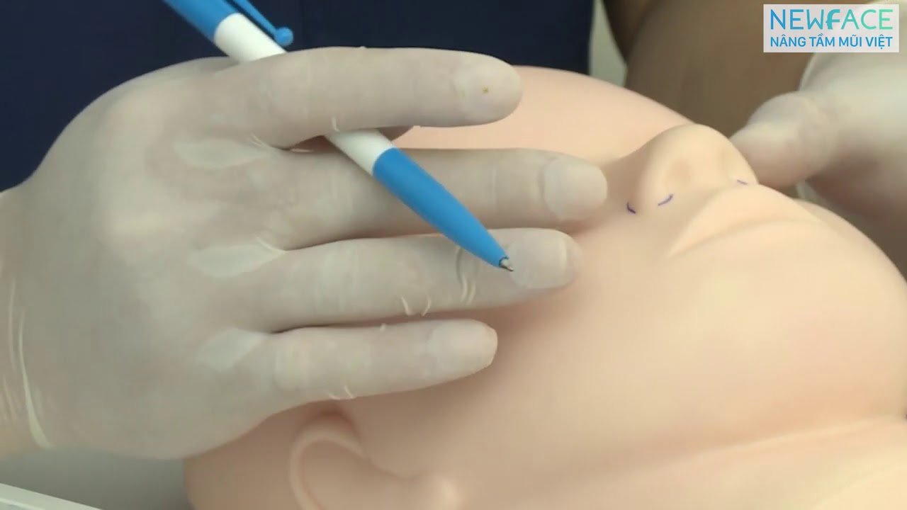 Bác Sĩ Trần Phương: Cắt Cánh Mũi Có Để Lại Sẹo Không?