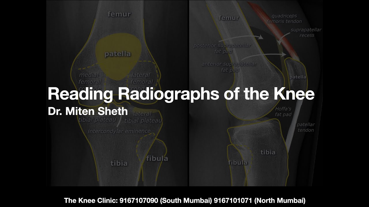 Reading Radiographs of the Knee
