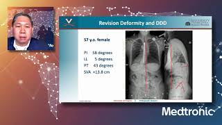 Lecture: Patient Selection and Medical Optimization in Adult Spinal Deformity