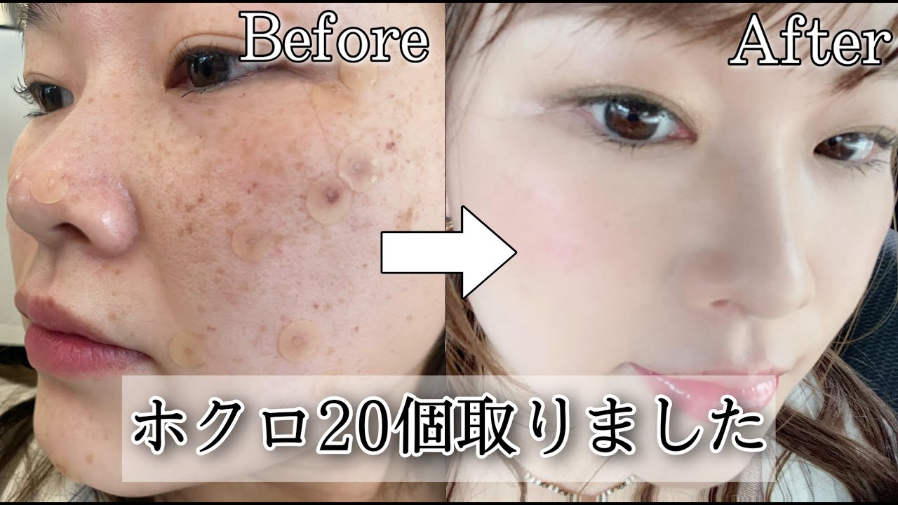 【ほくろ取り】大量のホクロとシミを取ったら人生変わった｜施術～ダウンタイムまで