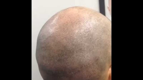 3d Scalp Micropigmentation Natural Scar Results with Chris 1 session