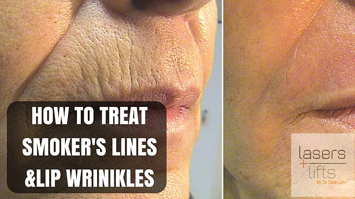 How to treat upper lip wrinkles and smoker's lines