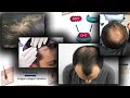 Will GT20029 Work? | Topical Anti-androgen route