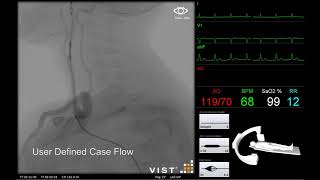 Carotid Intervention