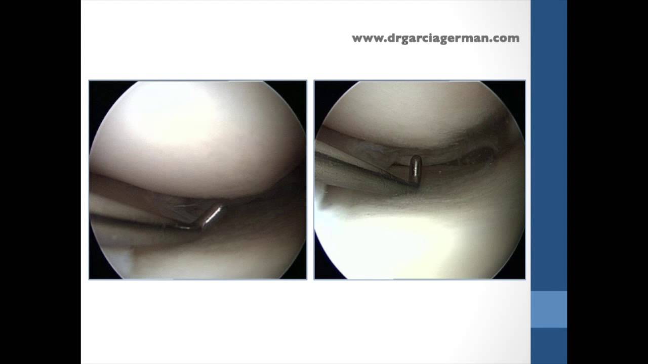 lesion ligamentos colaterales rodilla lesion ligamentos colaterales rodilla