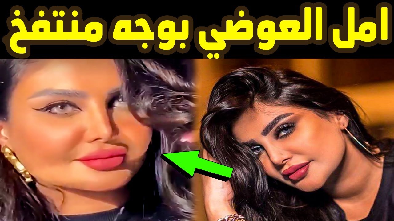 أمل العوضي الفنانة الكويتية امل العوضي تظهر بوجه منتفخ وتثير دهشة واستغراب جمهورها Youtube