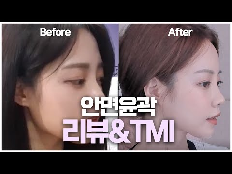 ENG) <strong>Face</strong> Outline TMI Total Cleanup <strong>Part</strong>  안면윤곽 성형 총 정리 리뷰