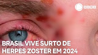 Brasil vive surto de herpes zoster em 2024