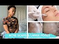 How to get rid of large pores and acne scars from a licensed esthetician | Brittany&#39;s Room