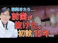 【 入れ歯 ・ 義歯 】朝起きたら、前歯 が抜けちゃってた… 「 部分入れ歯 ・ 初診 から15年の経過」口の中の変化に合わせて、ピッタリ合った 部分入れ歯 が、その時その時で、絶対に必要なんです！