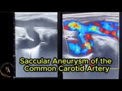 Saccular Aneurysm of the Common Carotid Artery – Vascular Ultrasound ...