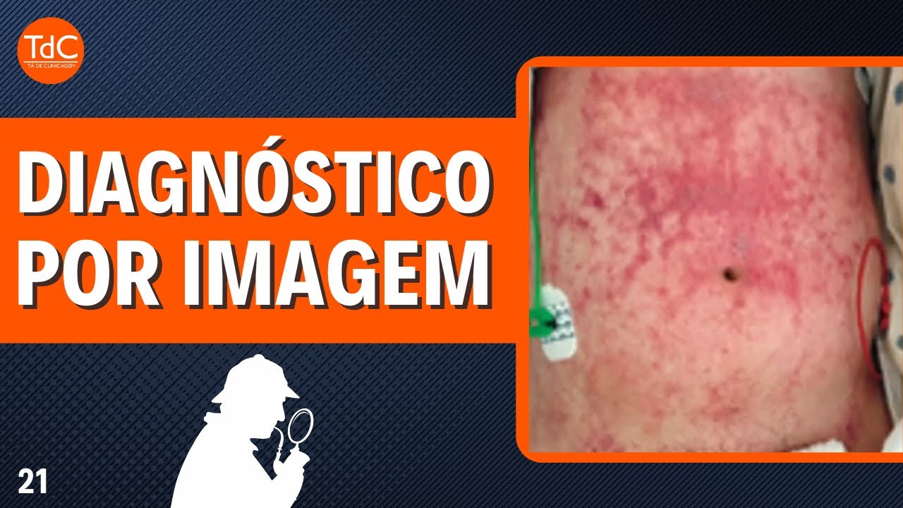 Thumbnail - "Rash, febre e hemoptise" l Desafio TdC 21