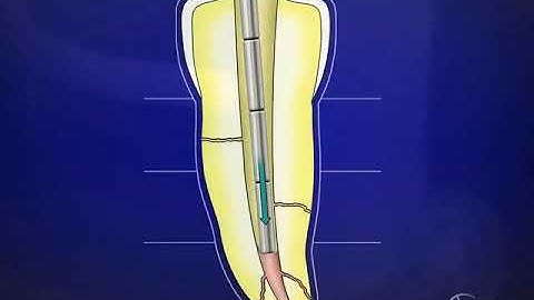 Vertical Condensation Technique: Step-by-Step Graphic Sequence