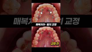 치과의사도 멈칫했습니다… 이건 예사롭지 않아요