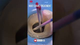 Root Canal Treatment step by step