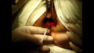 видео Операционное и безоперационное лечение анальной трещины
