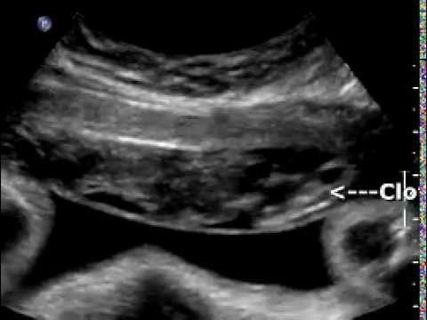 Subchorionic hemorrhage, anterior placenta - YouTube
