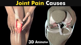 What Causes Joint Pain? | Osteoarthritis And Rheumatoid arthritis (3D Animation)